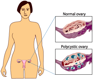 polycystic-ovary.gif